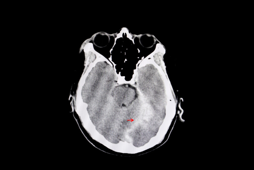 Traumatic brain injury claim